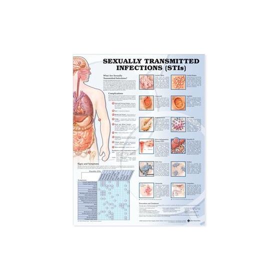 Sexually Transmitted Infections Anatomical Chart Laminated 20"x26"
