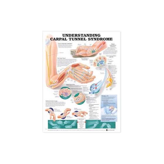  Understanding Carpal Tunnel Syndrome Anatomical Chart Laminated 20"x26"