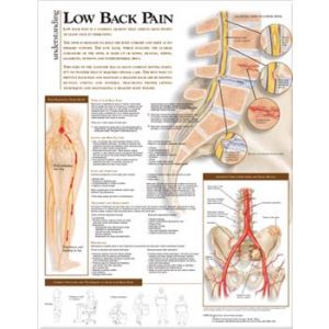 Understanding Low Back Pain Anatomical Chart Laminated 20"x26"