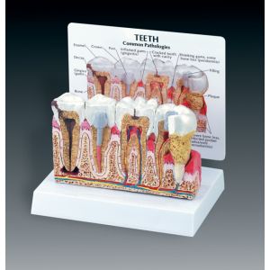 Diseased Teeth and Gums Model